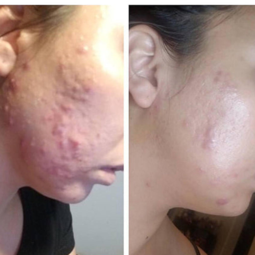 cream for hormonal acne
fast-acting acne spot treatment
reduce redness and inflammation
clear skin overnight cream
acne scar healing cream
anti-acne moisturizer
non-toxic acne treatment
gentle acne care for sensitive skin
tea tree oil acne cream
salicylic acid organic alternative
aloe vera acne treatment
cruelty-free acne solution
vegan acne skincare
soothing cream for acne-prone skin