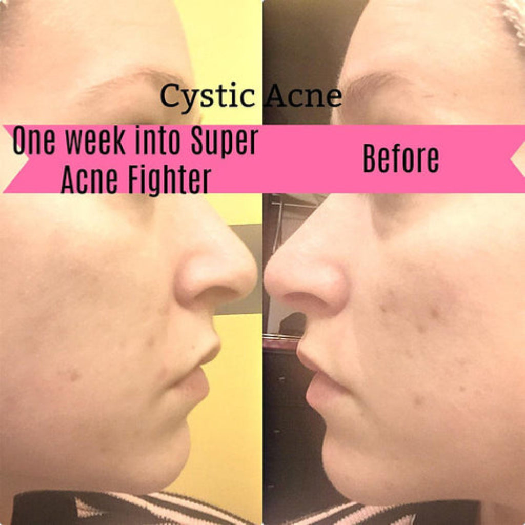 cream for hormonal acne
fast-acting acne spot treatment
reduce redness and inflammation
clear skin overnight cream
acne scar healing cream
anti-acne moisturizer
non-toxic acne treatment
gentle acne care for sensitive skin
tea tree oil acne cream
salicylic acid organic alternative
aloe vera acne treatment
cruelty-free acne solution
vegan acne skincare
soothing cream for acne-prone skin