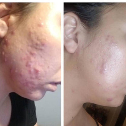 cream for hormonal acne
fast-acting acne spot treatment
reduce redness and inflammation
clear skin overnight cream
acne scar healing cream
anti-acne moisturizer
non-toxic acne treatment
gentle acne care for sensitive skin
tea tree oil acne cream
salicylic acid organic alternative
aloe vera acne treatment
cruelty-free acne solution
vegan acne skincare
soothing cream for acne-prone skin